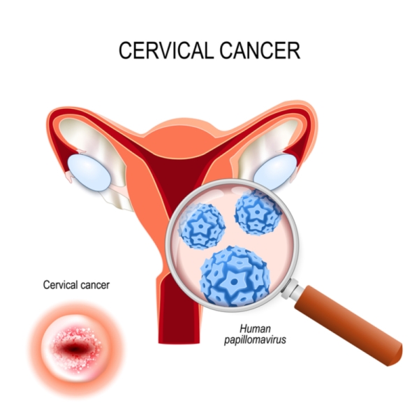 Ung thư cổ tử cung là do một số chủng HPV gây nên.