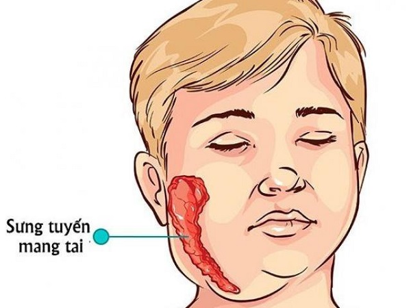 Quai bị là bệnh lành tính do virus ARN thuộc Rubulavirrus trong họ Paramyxoviridae gây ra