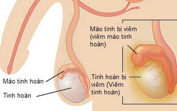 Biến chứng viêm tinh hoàn gây vô sinh ở nam giới khi bị quai bị