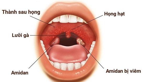 viêm họng hạt