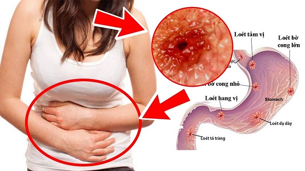 Viêm loét dạ dày - tá tràng gây ra những cơn đau khó chịu vùng bụng trên