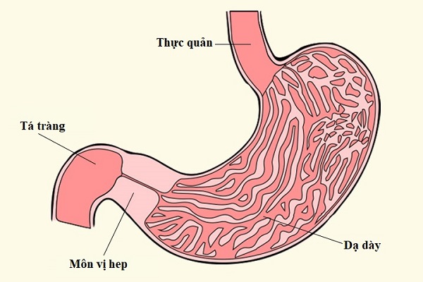 Viêm loét dạ dày - tá tràng có thể biến chứng thành hẹp môn vị