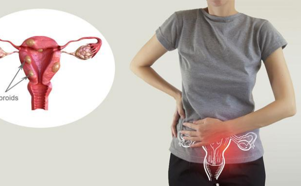Rối loạn kinh nguyệt là một trong những dấu hiệu u xơ tử cung