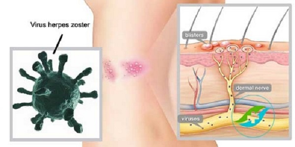 nguyên nhân gây bệnh zona thần kinh
