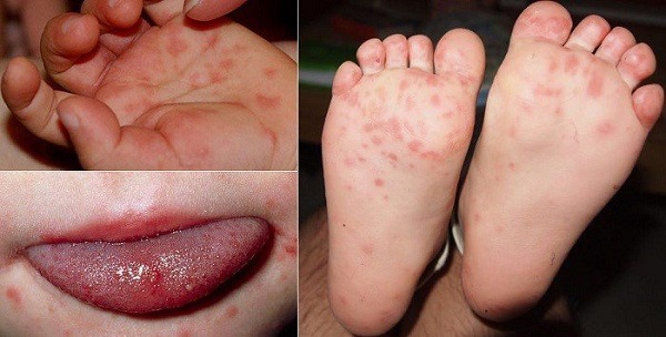 4 mức độ bệnh tay chân miệng