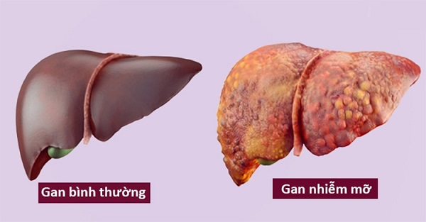 Gan nhiễm mỡ gây ảnh hưởng chức năng gan và đe dọa sức khỏe người bệnh