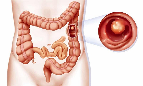 Polyp đại tràng là một khối nhỏ các tế bào hình thành trên niêm mạc đại tràng