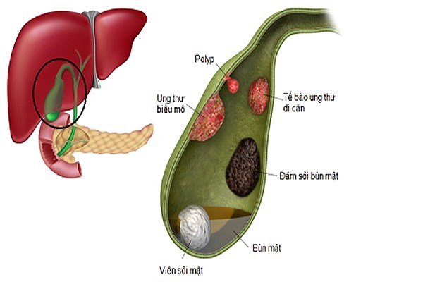 Polyp túi mật là những u thịt thừa phát triển bên trong túi mật