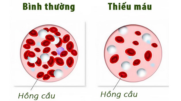 Chỉ số MCV thấp cảnh báo bệnh thiếu máu thiếu sắt, thalassemia, bệnh lý hồng cầu,... (ảnh minh họa)