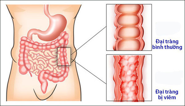 Viêm đại tràng là bệnh lý tiêu hóa thường gặp