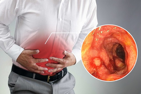 Viêm đại tràng có thể dẫn đến nhiều biến chứng nguy hiểm