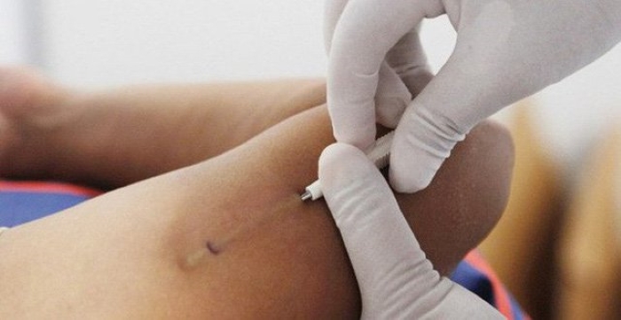 Đây là một thủ thuật đơn giản, diễn ra vô cùng nhẹ nhàng và nhanh chóng.