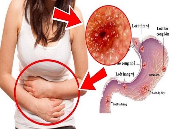 Nóng rát dạ dày có thể là triệu chứng của bệnh viêm loét, viêm dạ dày,...