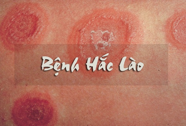 biểu hiện của bệnh hắc lào