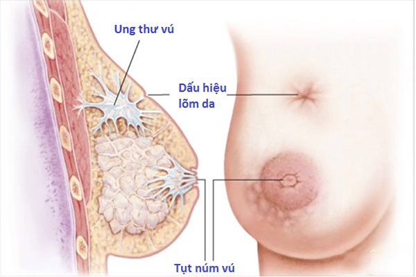 ung thứ vú là gì