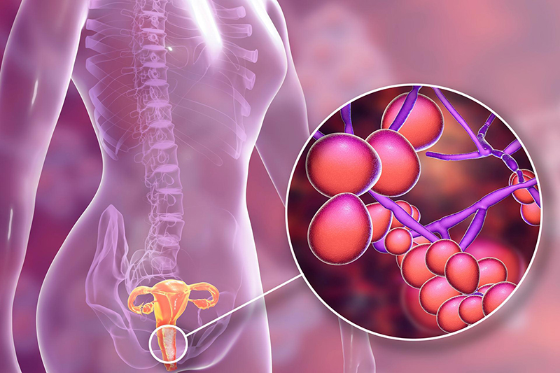 Candida albicans là loại nấm có hại nhất trong âm đạo phụ nữ.