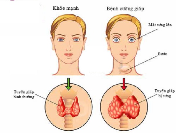 Cường giáp có biểu hiện u hoặc bướu ở cổ, mắt lồi,...