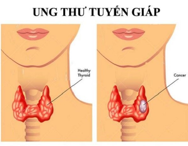 Ung thư tuyến giáp ngày càng phổ biến cần thăm khám sơm và điều trị kịp thời có thể chữa khỏi hoàn toàn