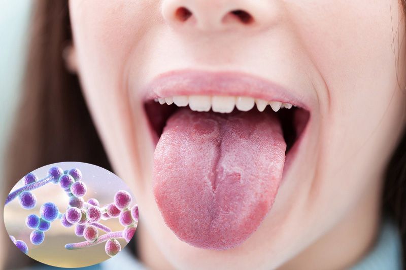 Khi bị nấm ở miệng, sẽ xuất hiện những đốm trắng trên lưỡi và miệng.