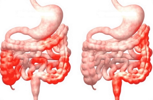 So sánh vị trí viêm của bệnh Crohn (bên trái) và viêm đại tràng (bên phải)