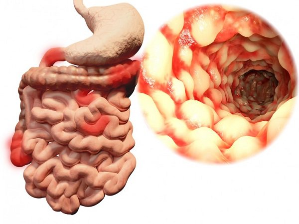 Nếu không được phát hiện và điều trị sớm, bệnh Crohn có thể dẫn đến nhiều biến chứng nguy hiểm