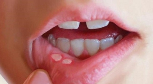 Nhiệt miệng là tình trạng viêm lớp niêm mạc miệng do nhiều yêu tố gây ra nhưng chủ yếu là do sự tấn công của virus, vi khuẩn gây bệnh.