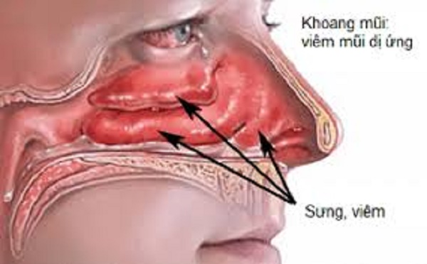 viêm mũi dị ứng là gì