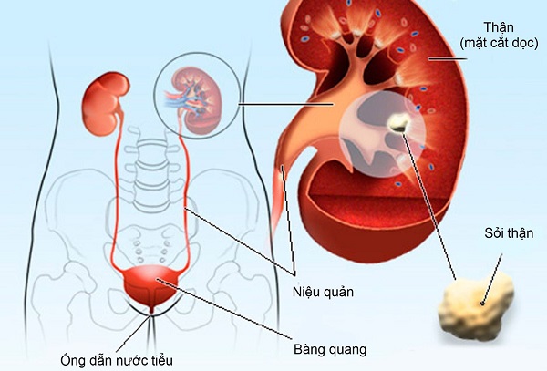 Cấu tạo hệ tiết niệu chứa sỏi tiết niệu