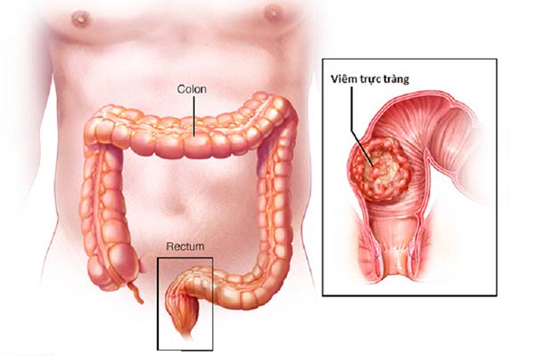 Trực tràng dễ bị vi khuẩn, virus tấn công gây viêm loét