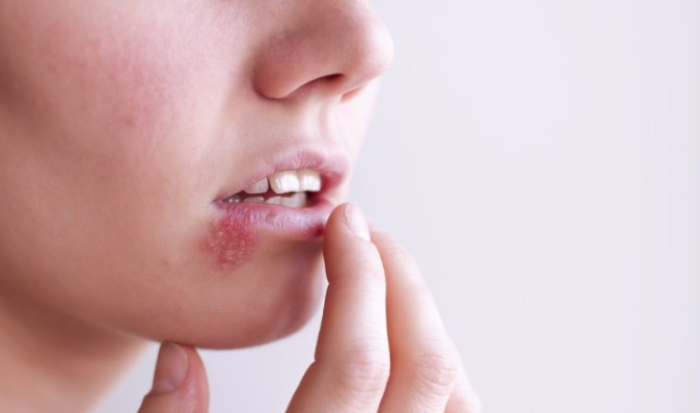 HSV loại 1 thường xuất hiện ở mắt hoặc quanh miệng.