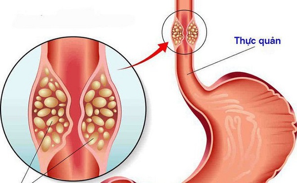 ung thư thực quản là gì