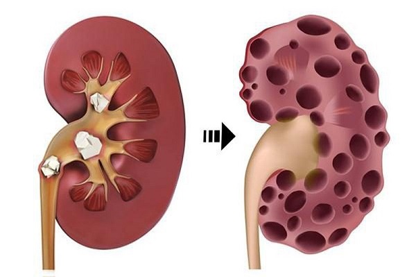 Sỏi là một trong những nguyên nhân suy thận