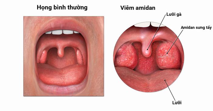 tu-a-den-z-ve-benh-viem-amidan-hoc-mu2