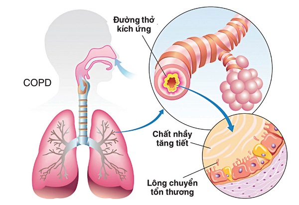 nguyên nhân gây bệnh phổi ắc nghẽn mạn tính