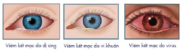 Nguyên nhân gây đau mắt đỏ do: virus, vi khuẩn, dị ứng