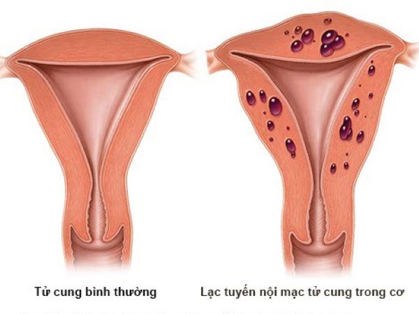 Lạc nội mạc tử cung là hiện tượng các tế bào bị trôi ngược vào vòi trứng buồng trứng, ổ bụng...