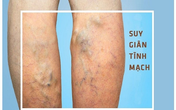 Suy giãn tĩnh mạch chân là gì?