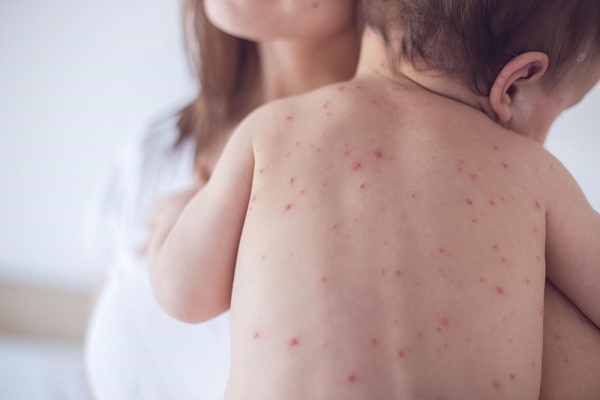 Bệnh thủy đậu là gì?
