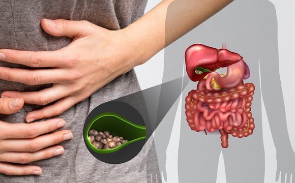 Sỏi mật gây đau dữ dội ở bụng trên bên phải