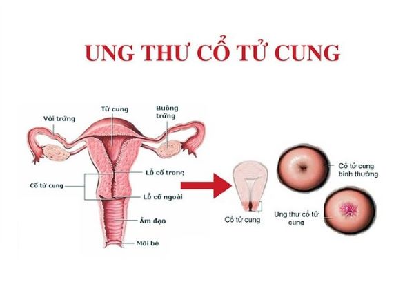 Ung thư cổ tử cung là khi cổ tử cung xuất hiện các khối u bất thường.