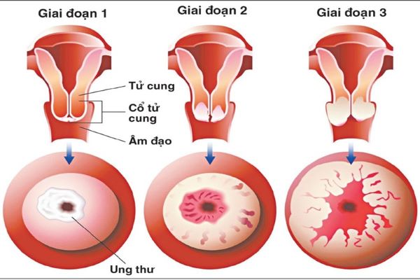 Các giai đoạn phát triển ung thư cổ tử cung.