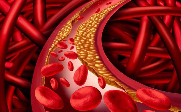 Chỉ số cholesterol cao là bao nhiêu?