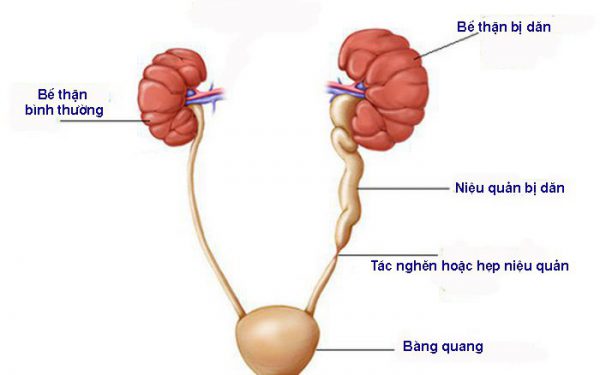 Giãn đài bể thận có thể gây nguy hiểm nếu không điều trị kịp thời