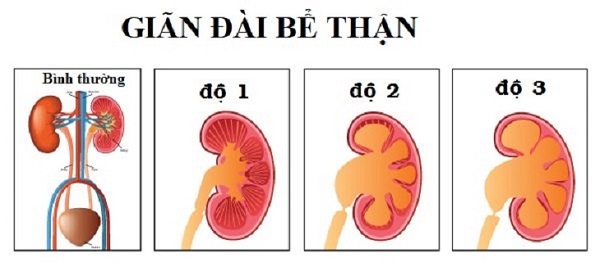 Giãn đài bể thận có các cấp độ khác nhau