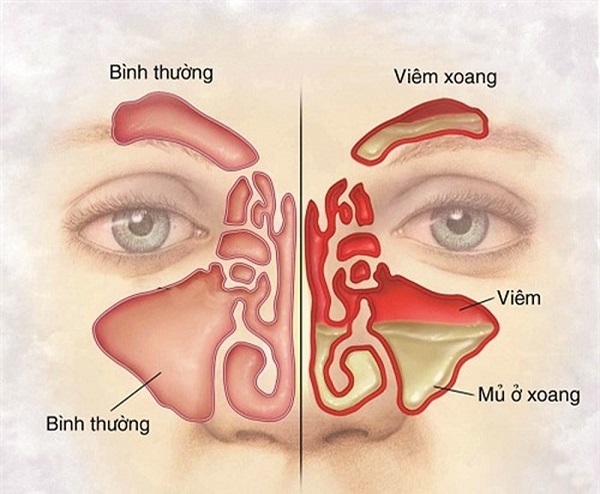 Viêm xoang là tình trạng viêm nhiễm ở xoang do các tác nhân gây bệnh