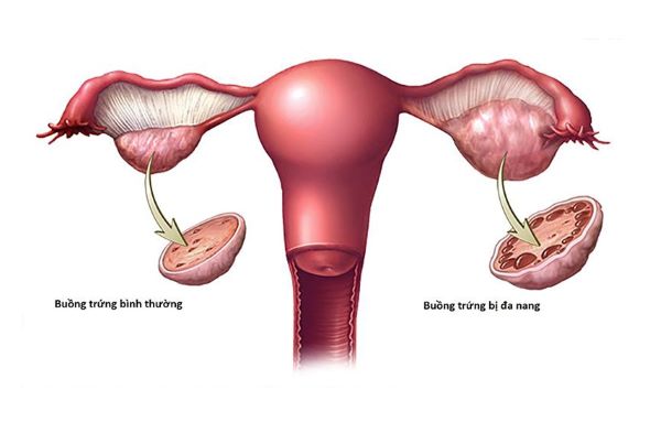 Buồng trứng đa nang là một hội chứng làm giảm khạ năng thụ thai và sinh sản của phụ nữ.