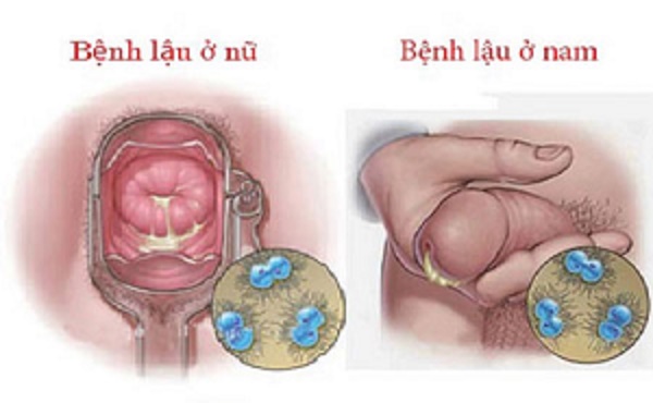 Dấu hiệu bệnh lậu ở nam và nữ giới