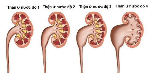Có 4 cấp độ thận ứ nước