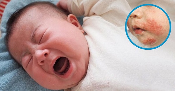 Biểu hiện viêm da cơ địa ở trẻ em