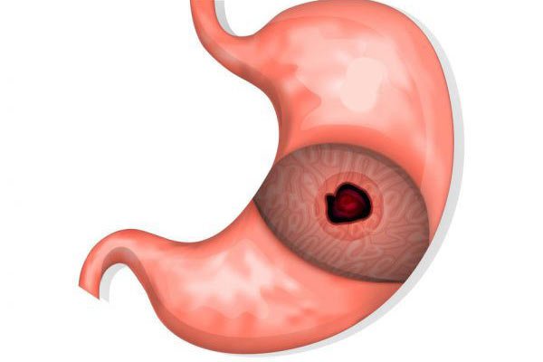 Thủng dạ dày cũng là một nguyên nhân gây đau vùng thượng vị